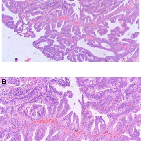 Prostatic Ductal Adenocarcinoma Tumor Cells Showing A Papillary Download Scientific Diagram