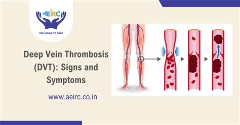 Signs And Symptoms Of Dvt Deep Vein Thrombosis Aeirc Clinic