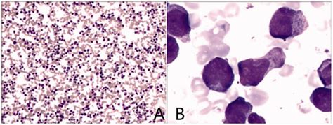 Bone Marrow Aspirate Infiltrated With Many Leukemic Promyelocytes This