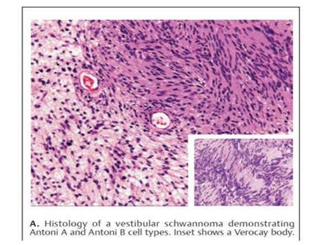 Tumors Of Middle And Inner Ear Dr Sithanandha Kumar 14 03 2016