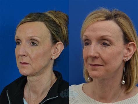 Facelift Before And After Pictures Case 68 Charlotte Nc Dilworth Facial Plastic Surgery