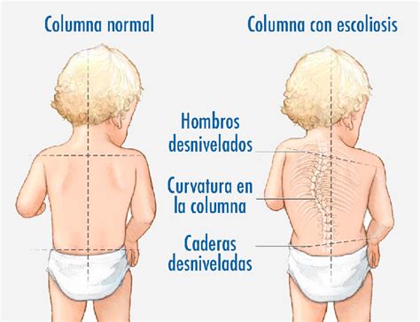 Escoliosis Tratamiento En Valencia Especialistas En Espalda