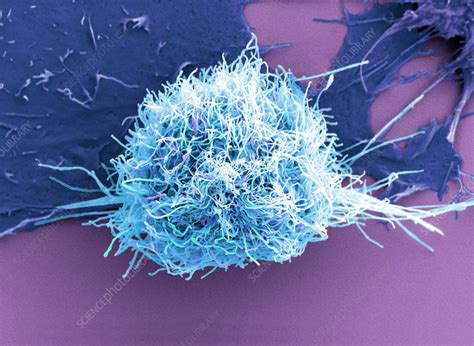 Cervical Cancer Cells SEM Stock Image C057 7238 Science Photo