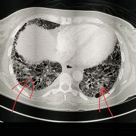 Lung Fibrosis Ct Scan