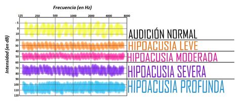 Audiometr As Lo Que Necesitas Saber