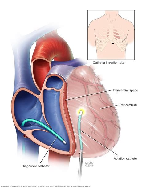 Ventricular tachycardia ablation - Type - Mayo Clinic