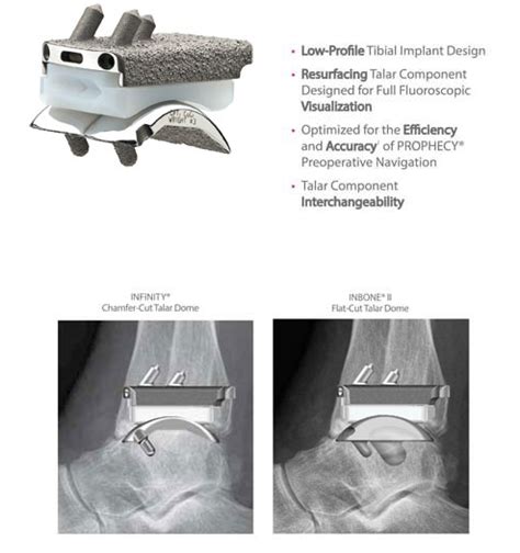 Foot And Ankle Archive Page 2 Of 5 Wright Medical Group