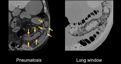 Abdominal CT Intestinal Ischaemia LITFL Radiology Library