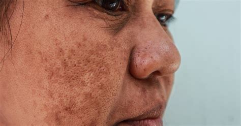 Melasma Mustache Causes Treatment Vs Age Spots More