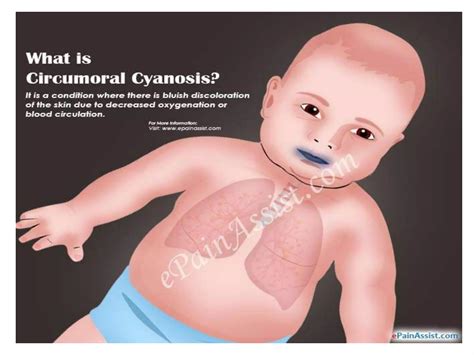 Meconium Aspiration Syndrome Ppt