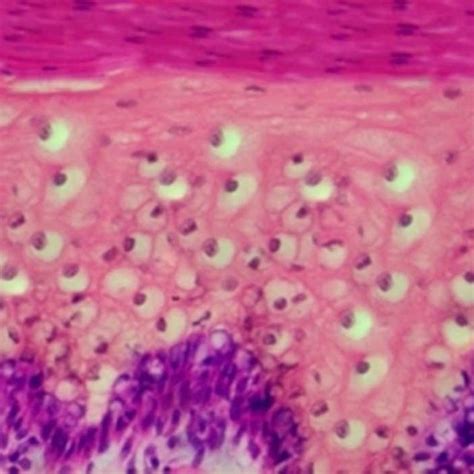 Photomicrograph showing Koilocytes in H&E stained section (X40 ...