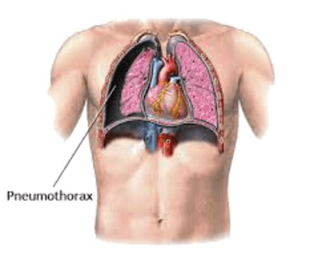 pneumothorax ex vacuo | Dentgap