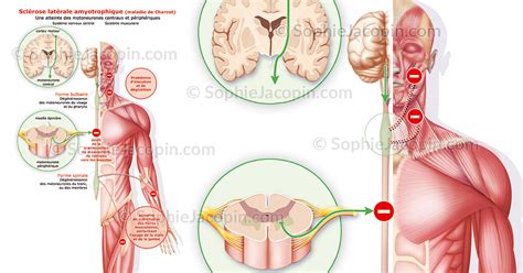 SCLÉROSE LATÉRALE AMYOTROPHIQUE illustration medicale Sophie