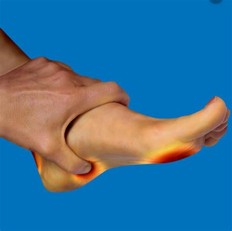 Abductor Digiti Minimi Foot Pain