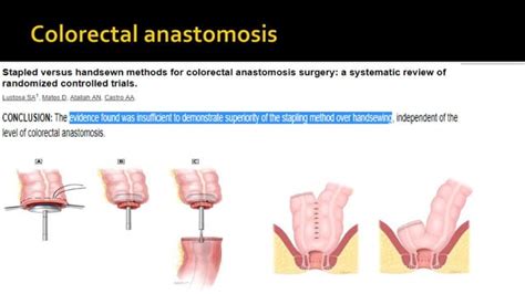 Bowel anastomosis