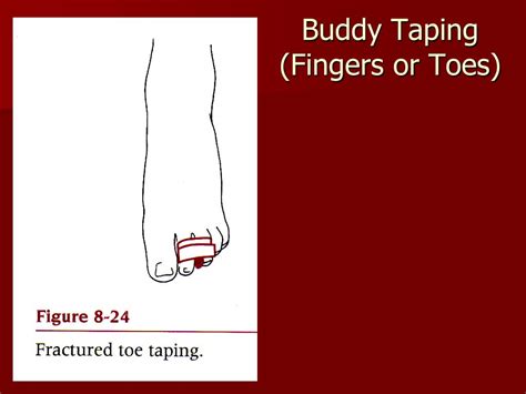 PPT - Chapter 8: Bandaging and Taping PowerPoint Presentation, free ...