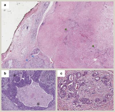 Carcinoma Ex Pleomorphic Adenoma Diagnostic Histopathology