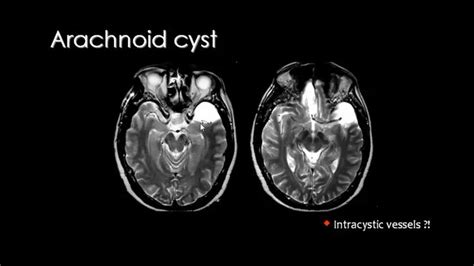 Intracranial Cysts Cysts Head And Neck Mri