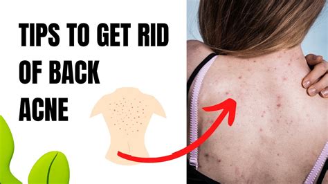 Natural Home Remedies For Back Acne Youtube