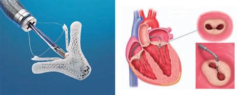 Tratamiento Percutáneo De La Insuficiencia Mitral Mitraclip Scite