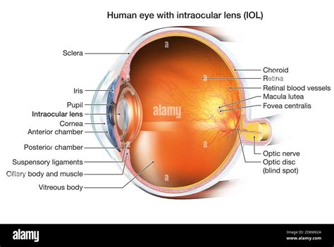 Medically 3D illustration showing human eye with intraocular lens (IOL ...