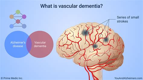 Slide Show Understanding Alzheimer S Disease