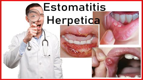 Estomatitis Herpetica Y Herpes Simple Etiologia Signos Sintomas