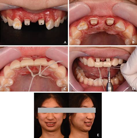 Digital Orthodontic Extrusion System For Complex Crown Root Fracture Of Anterior Teeth A