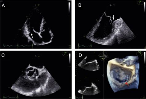 Ecocardiografía transtorácica y transesofágica Panel 1 A apical de 4