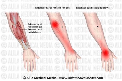 Alila Medical Media Trigger Points And Referred Pain For The Extensor Digitorum Medical