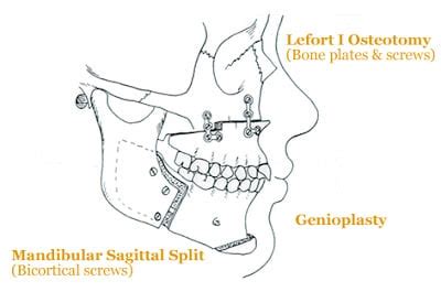 Jaw Surgery Los Angeles CA | Corrective Jaw Surgery