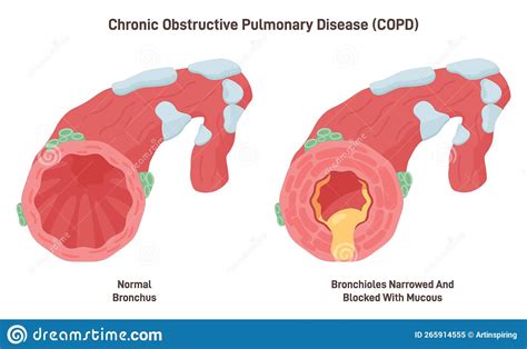 Chronic Obstructive Pulmonary Disease Chronic Inflammatory Lung Disease Stock Vector