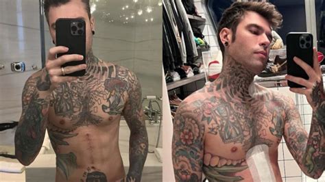 Fedez Mostra La Cicatrice Da Quando Mi Sono Operato Ho Perso Chili