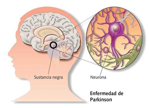 El Futuro De La Enfermedad De Parkinson Salud