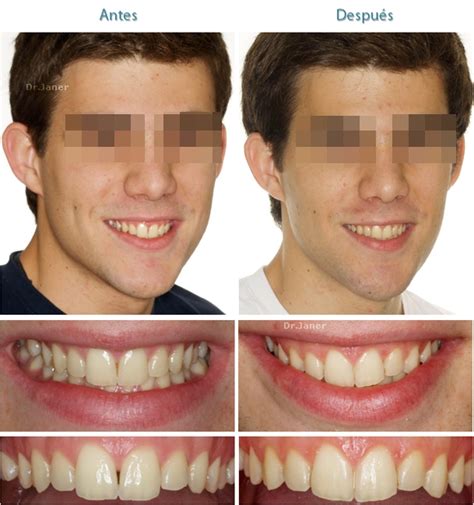 Simple 9 triángulo negro tronera dental abierta Damon