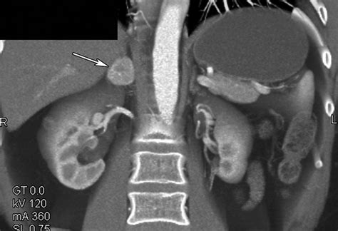 Adrenal Imaging With Multidetector CT Evidence Based Protocol