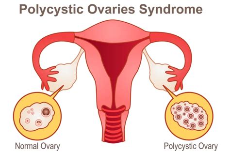 Bilateral Polycystic Ovarian Syndrome Khichdi Network Portal