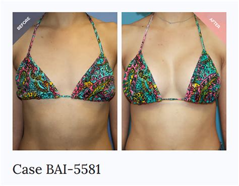 Breast Implants Before And After Dd