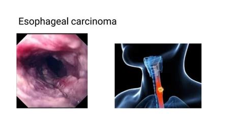 Esophageal Carcinomapdf