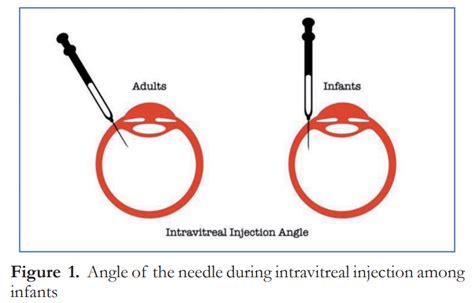 Avastin Intravitreal Injection