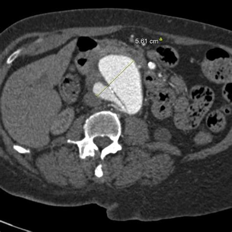 Preoperative Computed Tomography Ct Angiogram Shows A 56 Cm Aneurysm Download Scientific