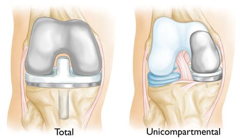 What is a total knee prosthesis | Orthoped