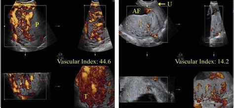 Can 3 Dimensional Power Doppler Indices Improve The Prenatal Diagnosis Of A Potentially Morbidly