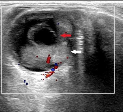 Axial Ultrasound View Of The Orbit Showing An Upper Choroidal