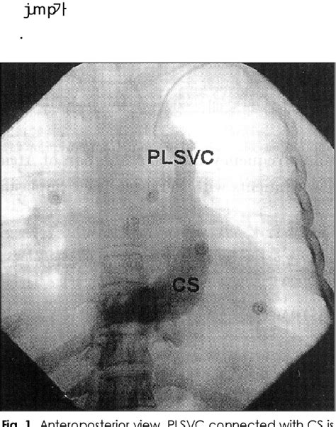 Figure From Radiofrequency Catheter Ablation Of Atrioventricular