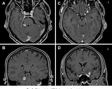 Figure 1 From A Clinical Suspected Case Of Cerebral Syphilitic Gumma