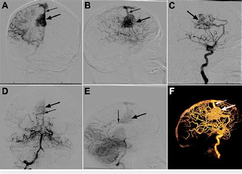 Preoperative Dsa A Anteroposterior And B Lateral Views Of Right