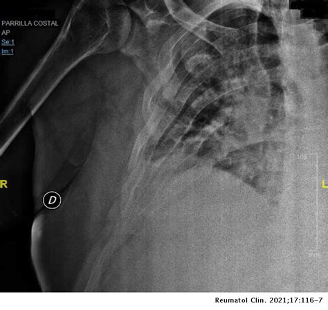 X-linked hypophosphatemic rickets: Diagnosis in adult and paucisymptomatic form | Reumatología ...