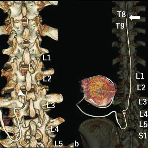 Intrathecal baclofen (ITB) pump implantation. ITB pump implantation was... | Download Scientific ...