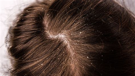 Dandruff vs. dry scalp: Differences and best treatments | FOX31 Denver